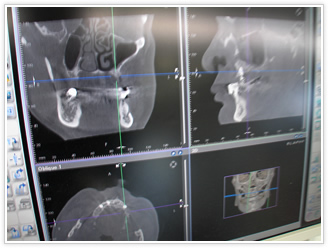 歯科用CT②